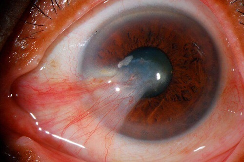 Simptomele unor boli oculare precum pinguecula