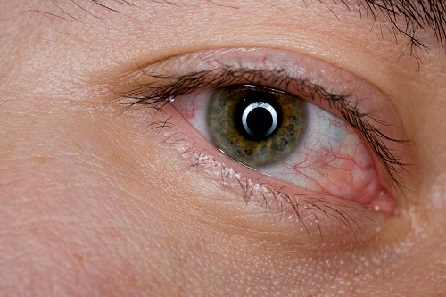 Simptomele unor boli oculare precum pterigionul