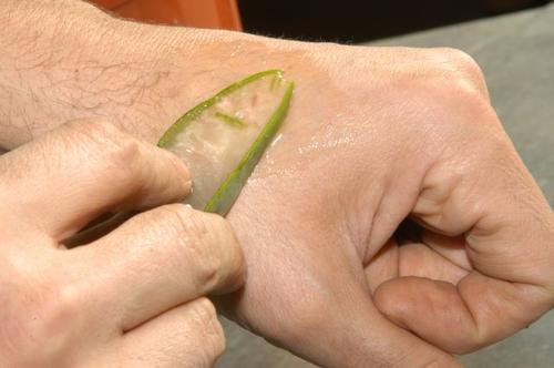 Vindecarea rănilor pe lista de beneficii ale gelului de aloe vera