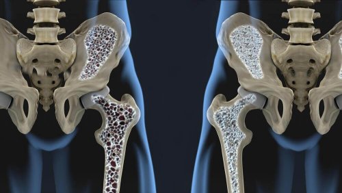 6 schimbări în dietă pentru prevenirea osteoporozei