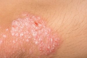 eczema endogena poze