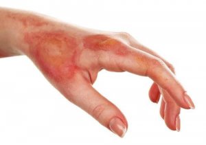 tratamentul arsurilor între degete curățare antiparazitară