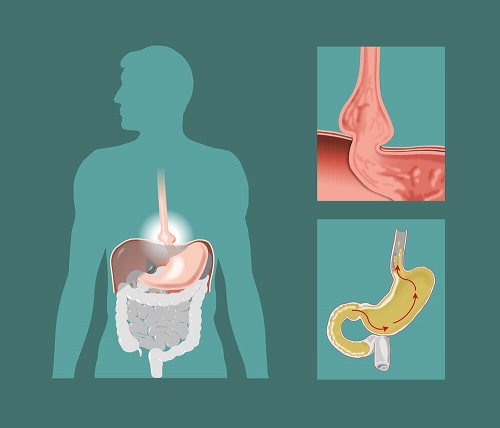 Henia hiatală este o afecțiune a sistemului digestiv