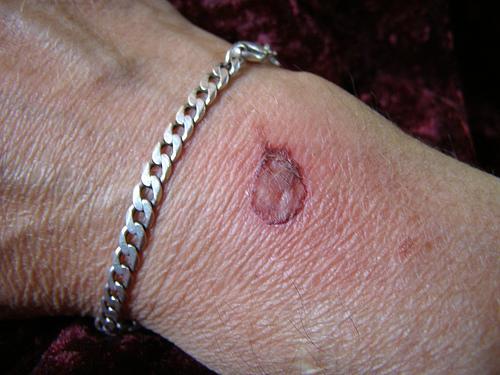 Remedii naturale pentru arsuri localizate pe mâini