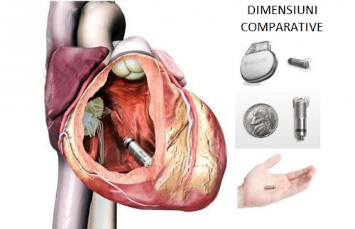 Stimulatoul cardiac Micra are mărimea unei monede de 1 euro