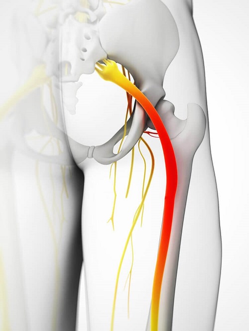 Durerea nervului sciatic se resimte în întreaga zonă inferioară a corpului