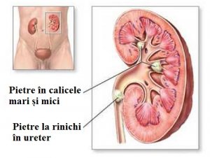 5 băuturi din plante care previn pietrele la rinichi