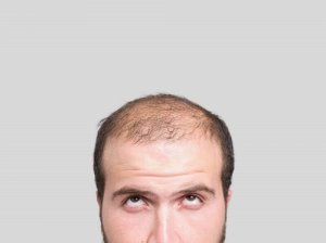Cum să scapi de chelie cu 3 remedii naturale