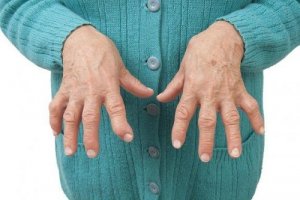cum să tratezi artrita reumatoidă la domiciliu