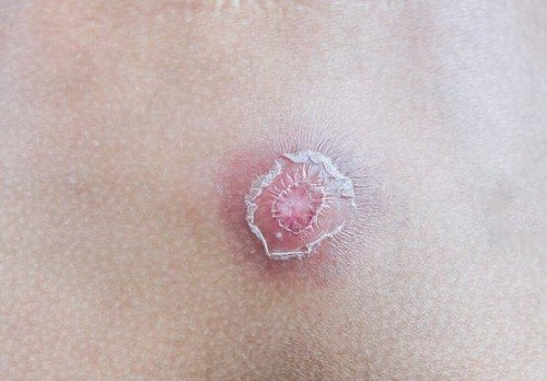 Ce sunt furunculele? 7 sfaturi pentru a scăpa de ele