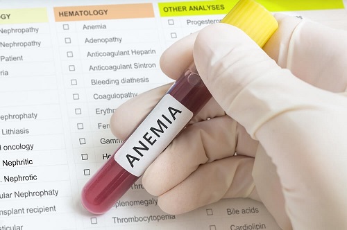 Anemia evidențiată prin analize de sânge