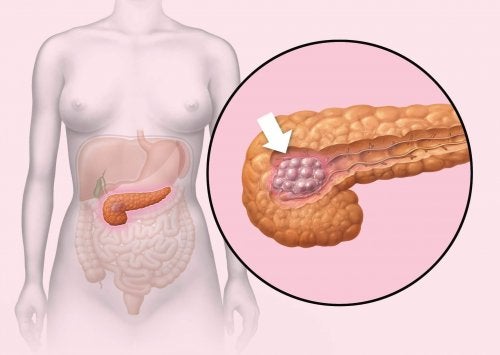 Cancer pancreatic la femei