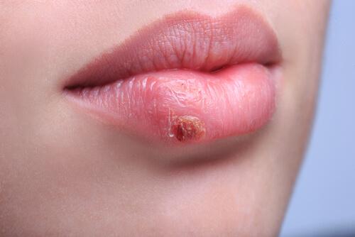 Femeie cu herpes pe buze