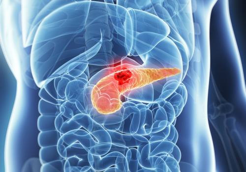 Primele simptome hormonale ale cancerului pancreatic