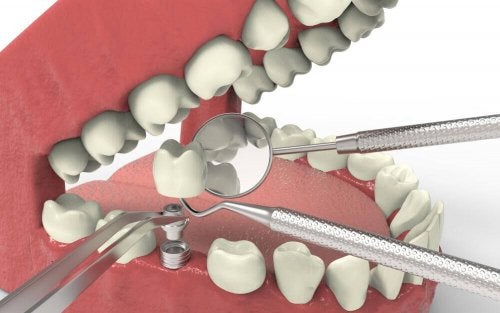 Tratamente pentru agenezia dentară prin implanturi