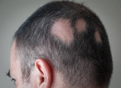 Bărbat care are nevoie de un tratament natural pentru alopecie
