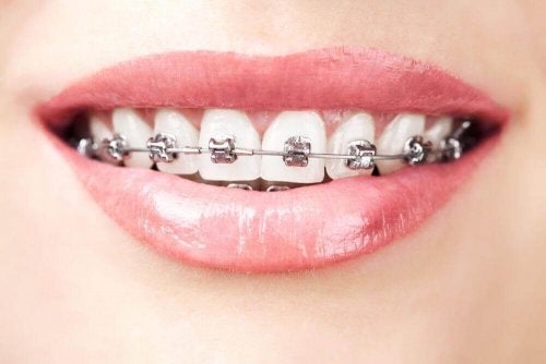 Dinți cu aparat dentar