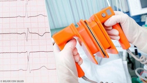 Diagnostic pentru fibrilația atrială