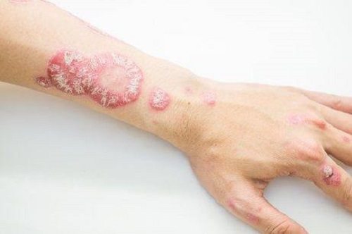 Nevoia de tratamente din plante pentru psoriazis pe mână