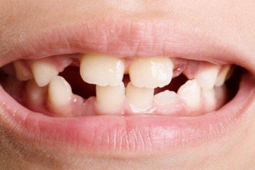 Tipuri și tratamente pentru agenezia dentară