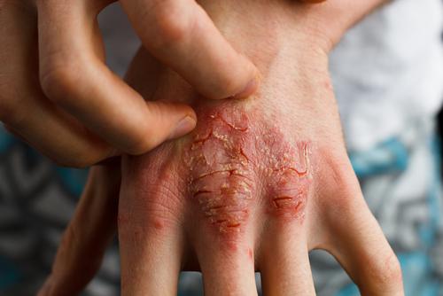 Poți să dormi mai bine dacă ai artrită psoriazică