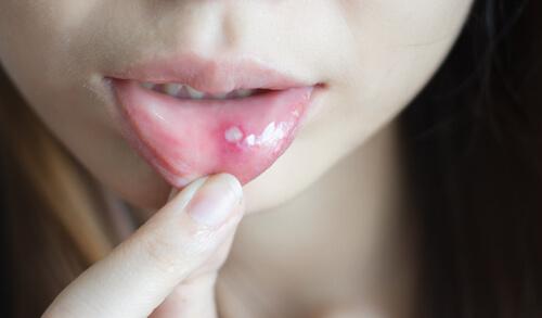 Tratament pentru ulcerațiile și aftele bucale