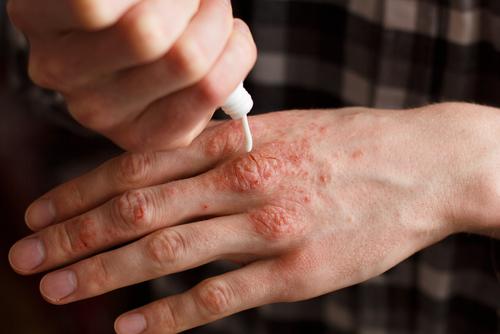 Remediu hidratant pentru artrita psoriazică