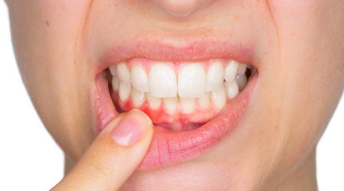 Tratament pentru abcesul dentar