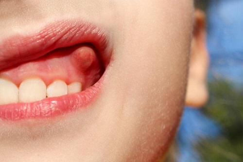 Nevoia de tratament pentru abcesul dentar