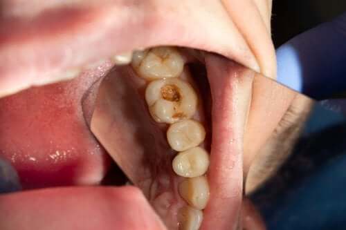 Cauzele apariției cariilor dentare