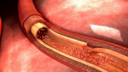 Ce este disecția aortică și care sunt cauzele sale