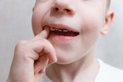 Copil cu dinți cariați