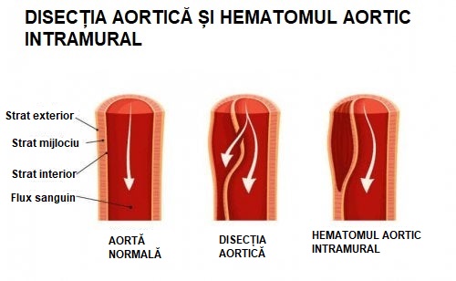 Ce este disecția aortică și hematomul aortic