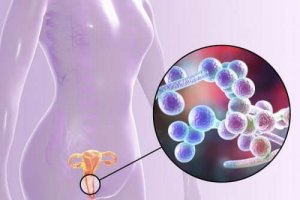Infecția vaginală cu Candida: ce trebuie să știi