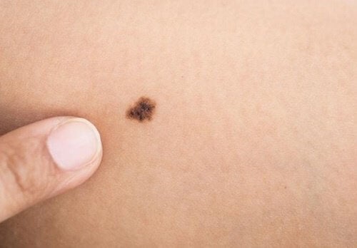 Testul abcde pentru cancerul de piele efectuat pe o aluniță