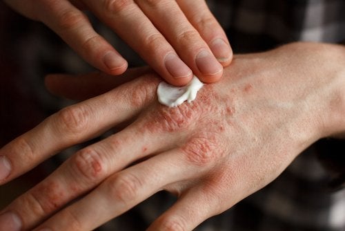 Modalități de a ameliora psoriazisul cu creme
