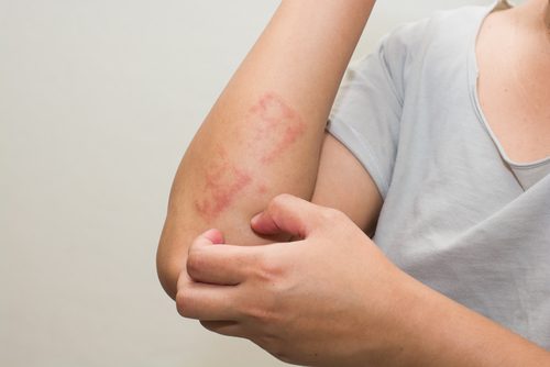 Femeie care caută modalități de a ameliora psoriazisul
