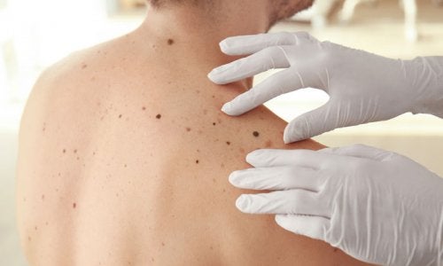 Testul abcde pentru cancerul de piele făcut de medic