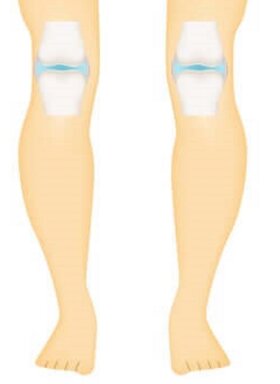 glezna umflată decât pentru a trata artroza diagnosticului articulației genunchiului