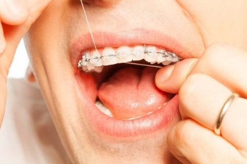 Igiena orală cu aparat dentar