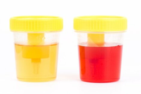 eliminare cheaguri de sange in urina)