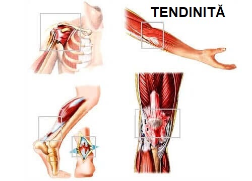 Reprezentare grafică a tendinitei