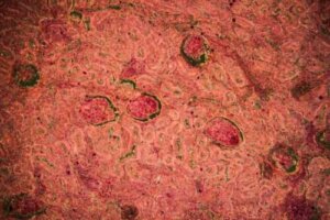 Diagnostic și tratamente pentru tuberculoza renală