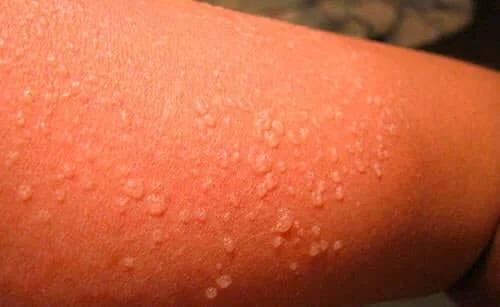 Bășicile dovedesc cum afectează coronavirusul pielea