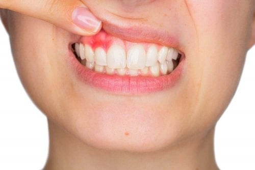 Femeie cu gingii inflamate