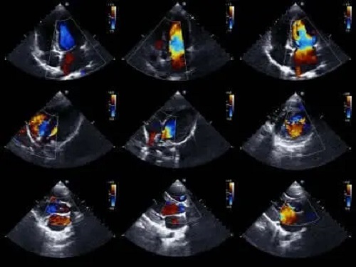 Ecocardiografia inimii