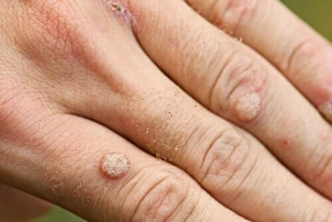 Modalitatile de tratare a negilor | Hebra Dermatologie