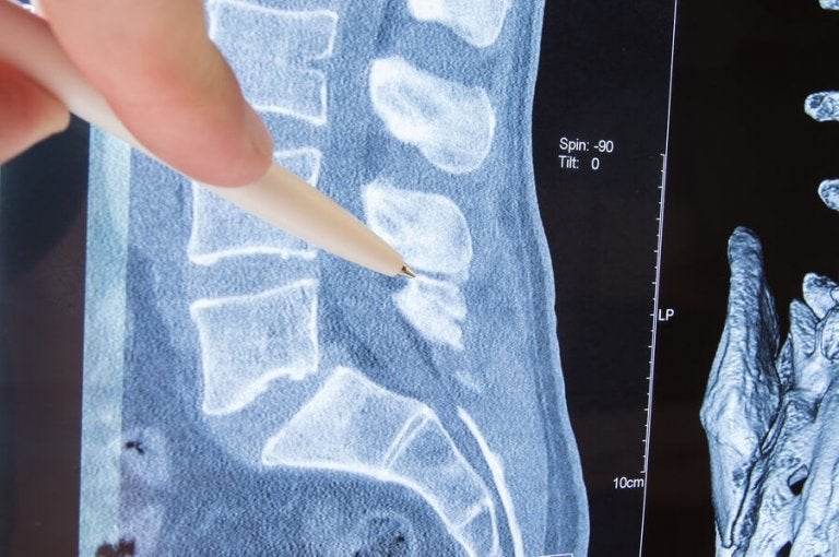 Ce este radiculopatia? Cauze, simptome și tratament