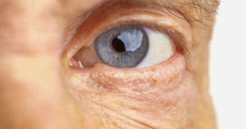 Ochi afectat de degenerescența maculară legată de vârstă