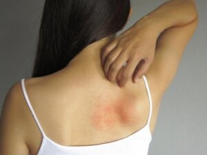 5 remedii topice pentru erupțiile cutanate